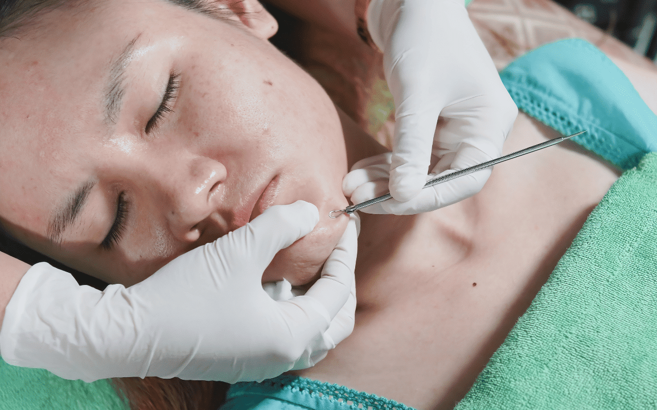 Van grove poriën tot acne-littekens: met deze 3 methodes krijg je weer een egale huid