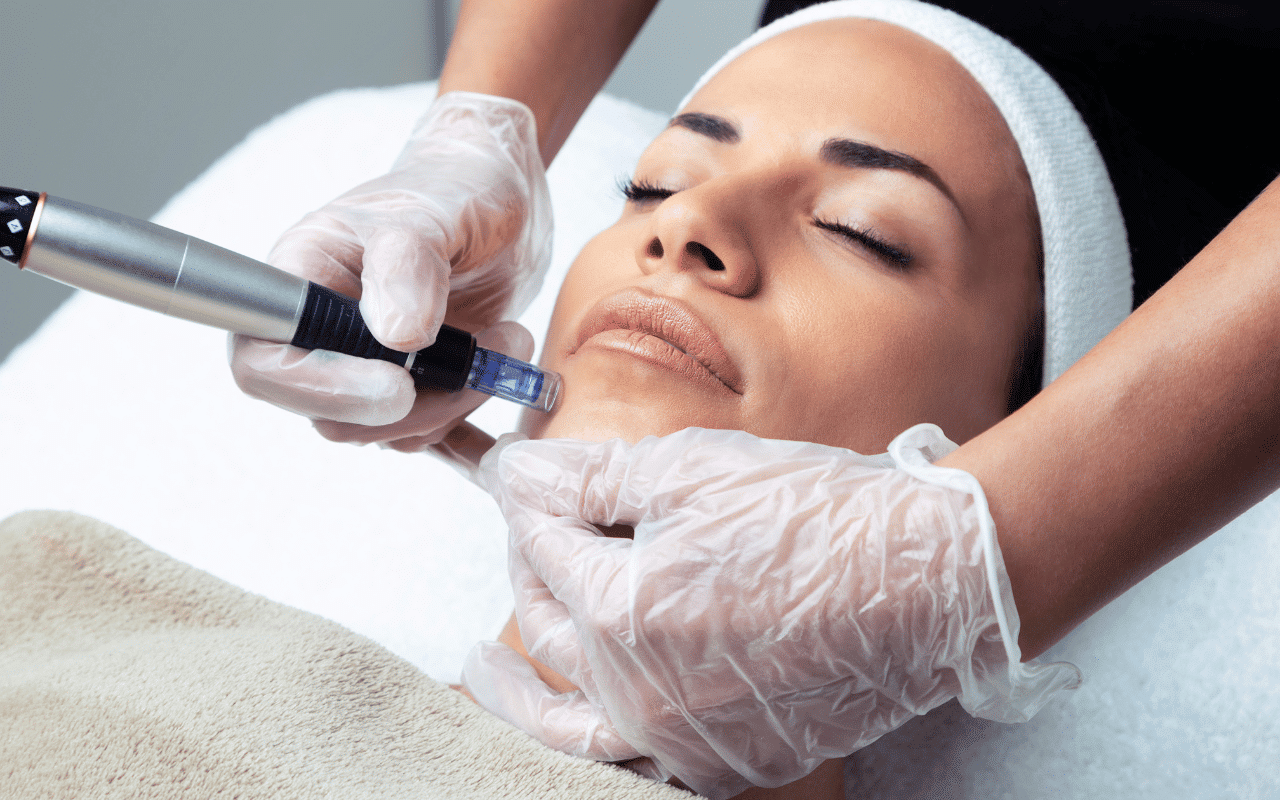 Iedereen wil de ‘Glass Skin’: waarom Microneedling de meest geboekte behandeling van 2025 is